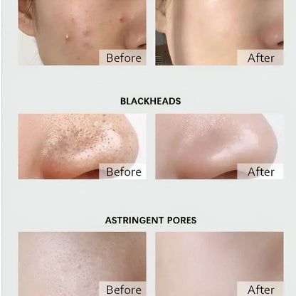 Before and after results using Dr. Rashel cleansing pads for acne, blackheads, and pores